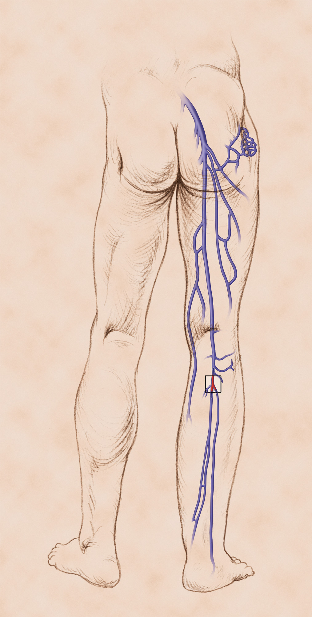Deep vein thrombosis (DVT) in leg