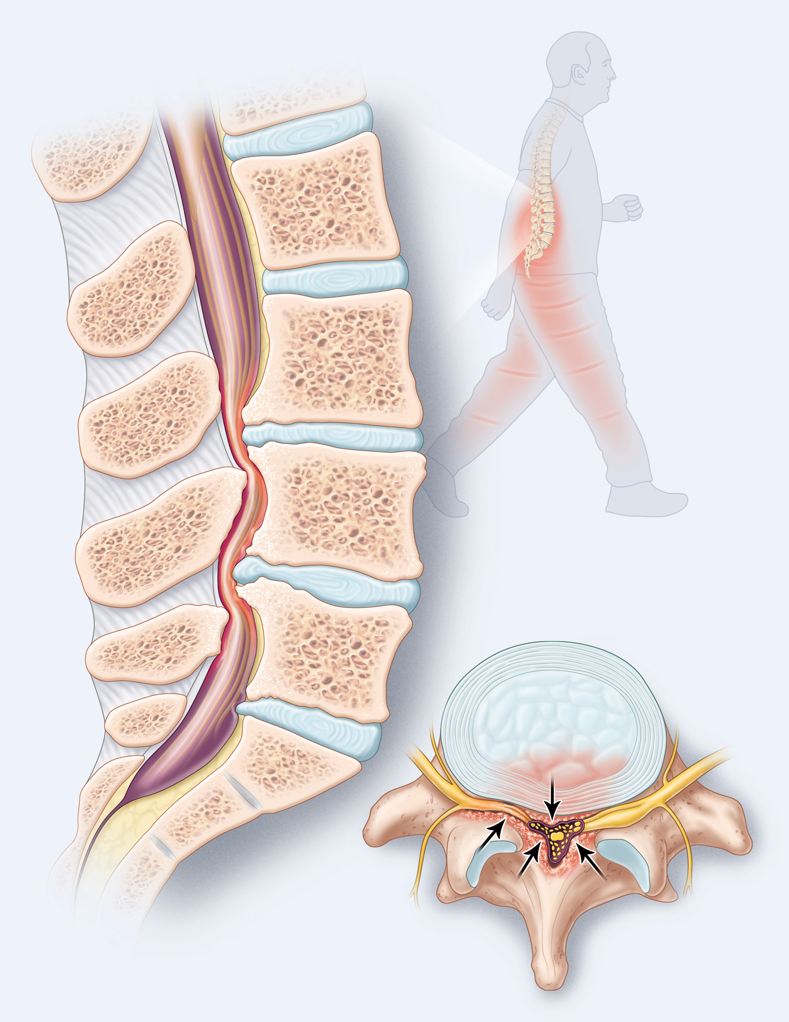 Lumbar spinal stenosis back pain
