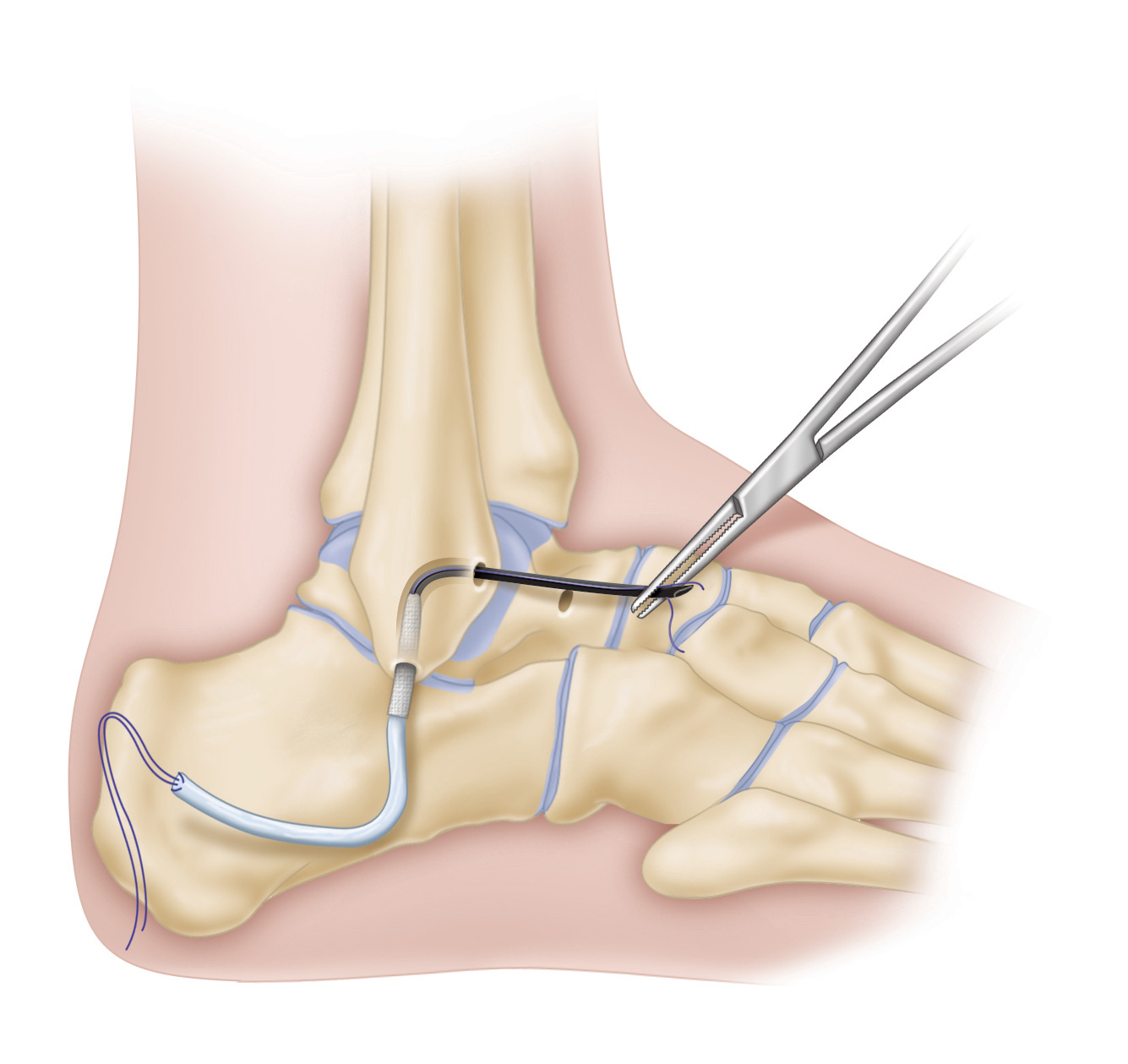 Ankle repair