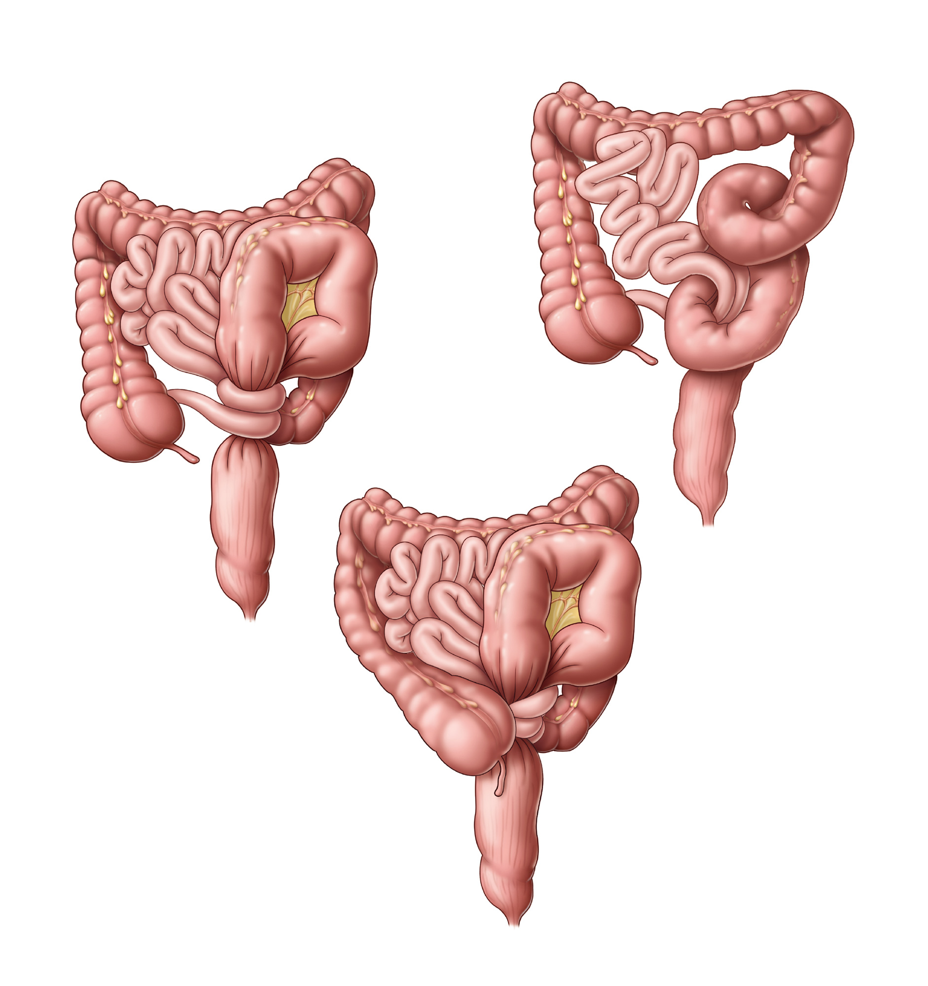 Bowel obstruction (volvulus)