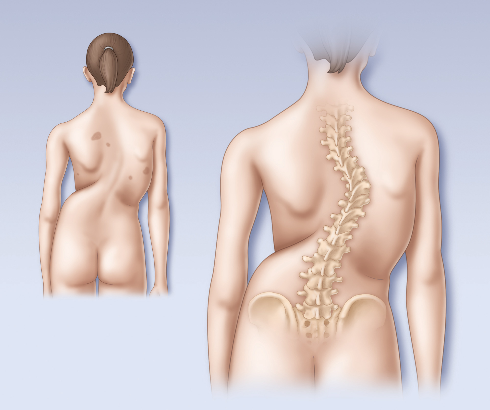 Scoliosis spine posterior view